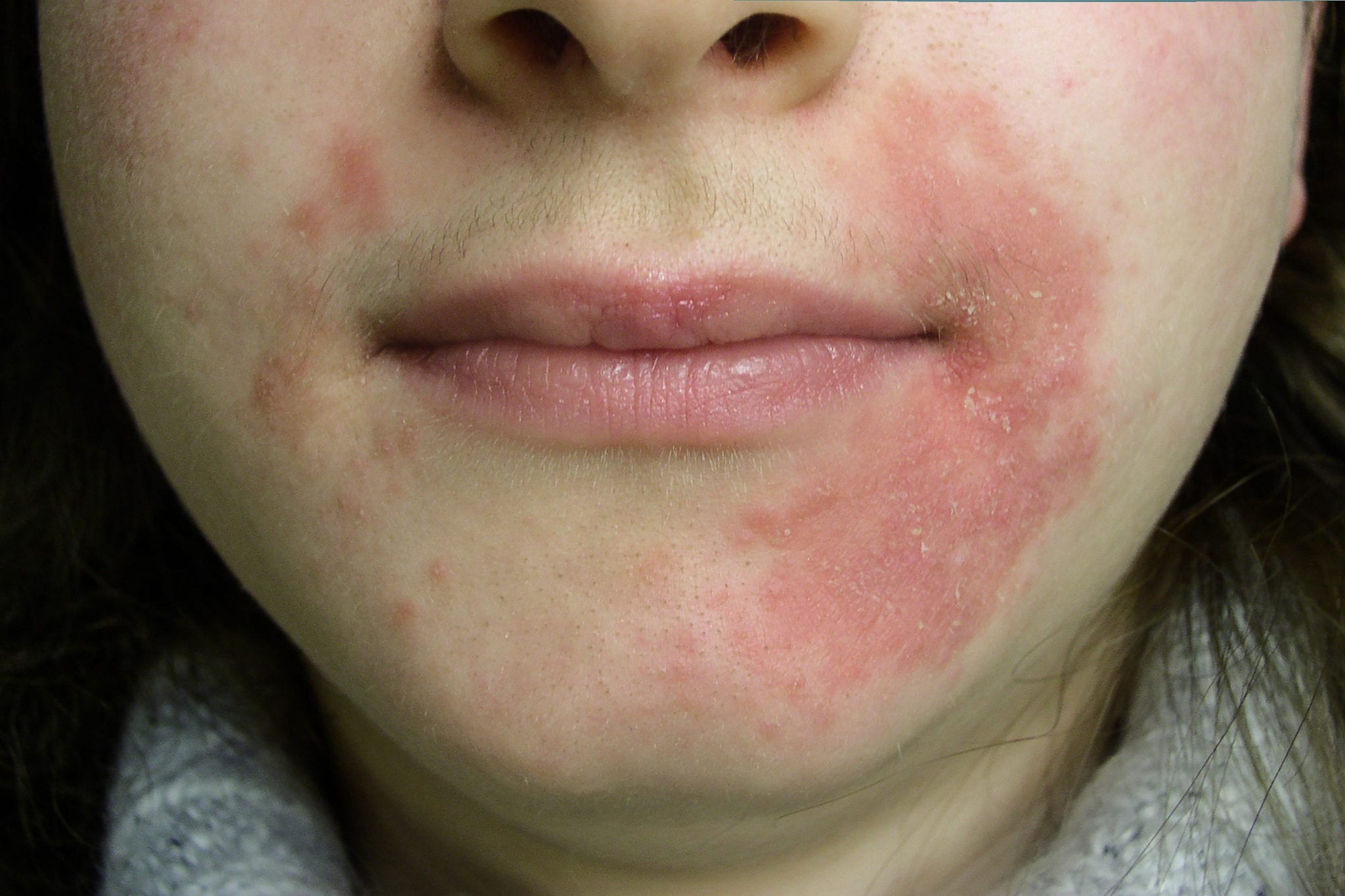 perioral-dermatitis-skin-rash-around-the-mouth-healthhype-com-my-xxx