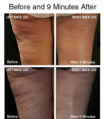 Cellulite Serum before and after